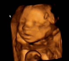 Ultrazvuk - Výraz miminka v bříšku může napovídat o psychické pohodě matky